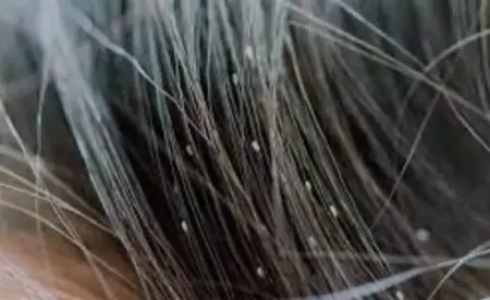 Rambut Banyak Telur Kutu ? Begini Cara Menghilangkannya ! telur-kutu-rambut