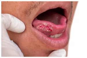 Kanker Mulut, Kenali Stadium, Gejala dan Penanganannya !