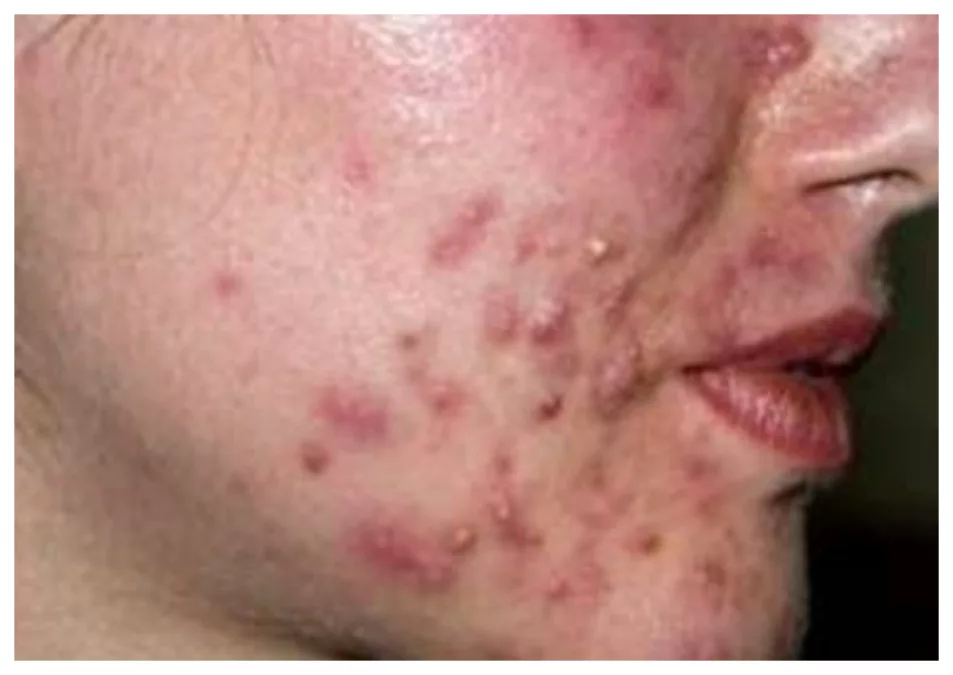 Cara Efektif Mengatasi dan Mencegah Jerawat Batu