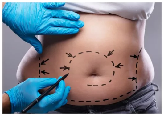 Benarkah Sedot Lemak Bisa Menurunkan Berat Badan? Inilah Faktanya!