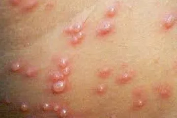 Sejumlah Siswa SMAN 5 Bandung Terkena Cacar Air, Sekolah Terapkan Pembelajaran Online Iustrasi Penyakit Cacar Air