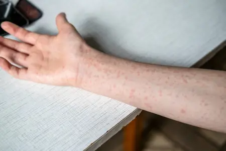 Kasus Campak di Indonesia Capai 8.372 hingga Pekan ke-8 2026, Enam Orang Dilaporkan Meninggal
