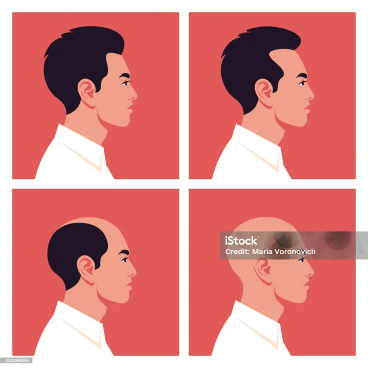 Rambut mendadak botak berbentuk bulat bisa menjadi tanda alopecia areata Sumber: istockphoto