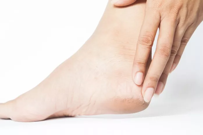 Kulit Kaki Pecah-Pecah? Ketahuilah, Ini Beberapa Faktor Risiko yang Menyebabkannya