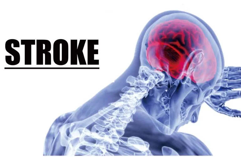 4 Makanan yang Membantu Kurangi Risiko Serangan Stroke, Salah Satunya Protein